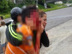 베네수엘라서 시위 참여한 16살 소년 고무탄 맞아 두 눈 실명